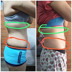 Resultados, electrolipolisis